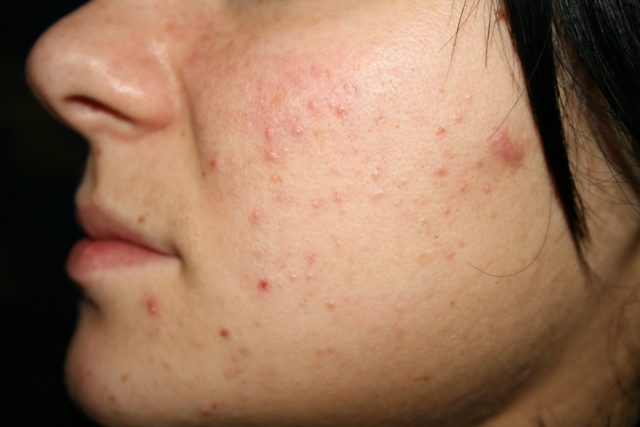 Наиболее распространенной формой акне является acne vulgaris (вульгарные акне) — сыпь, которая поражает кожу многих подростков