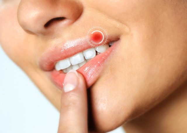 Параллельно с лёгкими пощипываниями на губах может появиться зуд по всему лицу