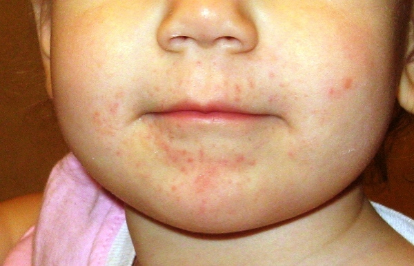 Ребенок может часто касаться подбородка и зоны под носом грязными руками, что приведет к возникновению прыщей 